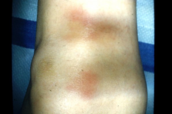 Erythema nodosum