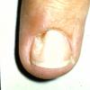 ganglion cyst nail bed