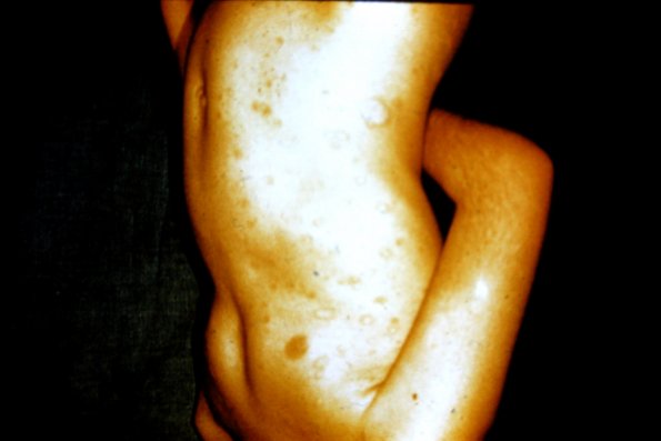 Pityriasis Rosea (4)