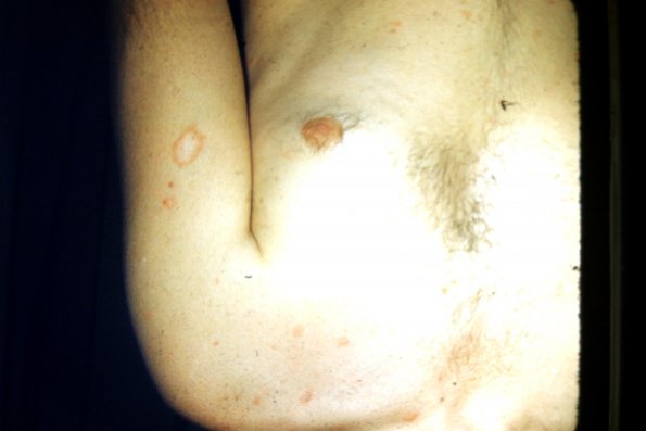 Pityriasis Rosea