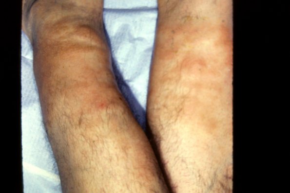 Pretibal Myxedema (2)