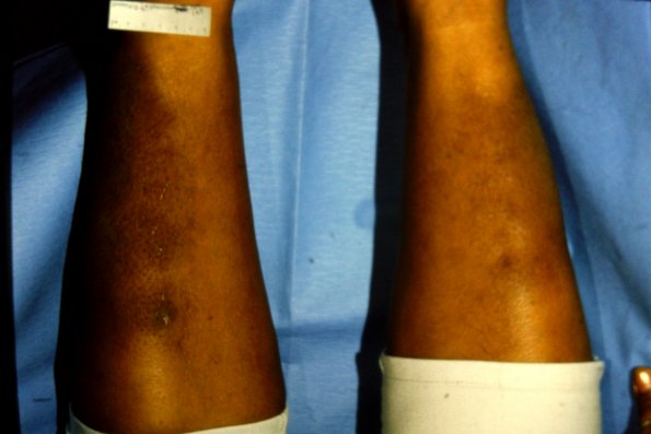 Pretibial Myxedema