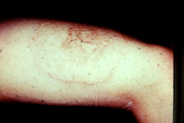 Tinea Corporis (10)