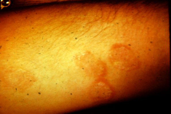 Tinea Corporis (11)