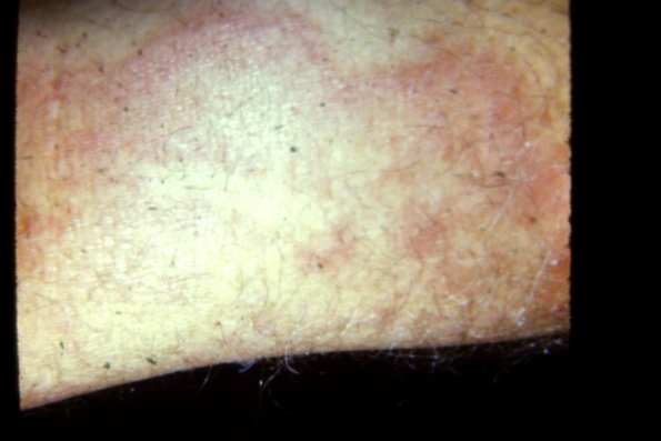 Tinea Corporis (12)