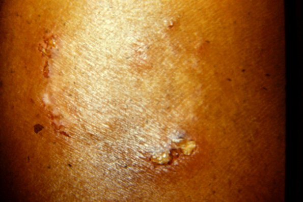 Tinea Corporis (14)