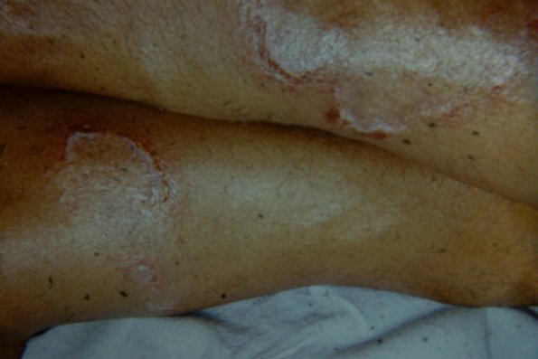 Tinea Corporis (15)