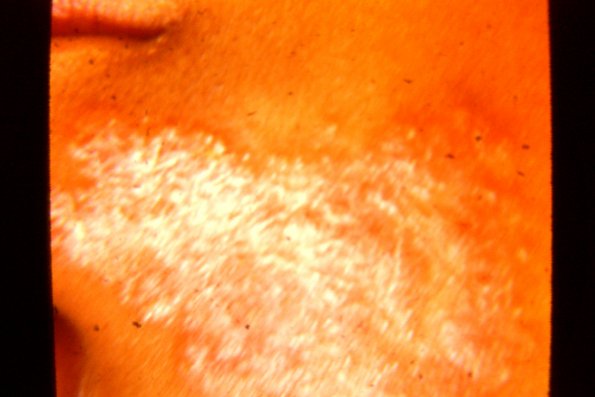 Tinea Corporis (17)