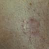 Tinea Corporis (2)