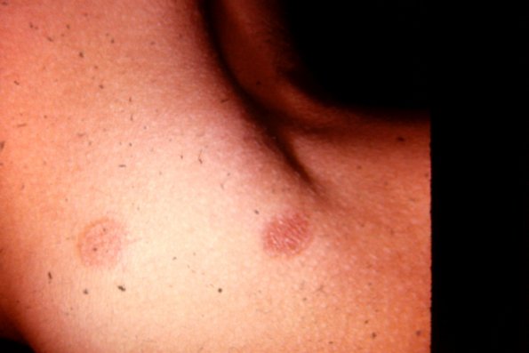 Tinea Corporis (25)