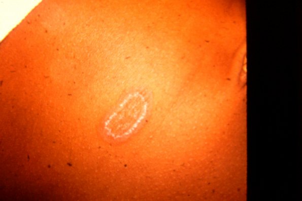 Tinea Corporis (27)