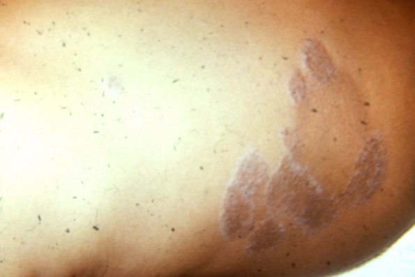 Tinea Corporis (36)