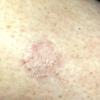 Tinea Corporis (5)