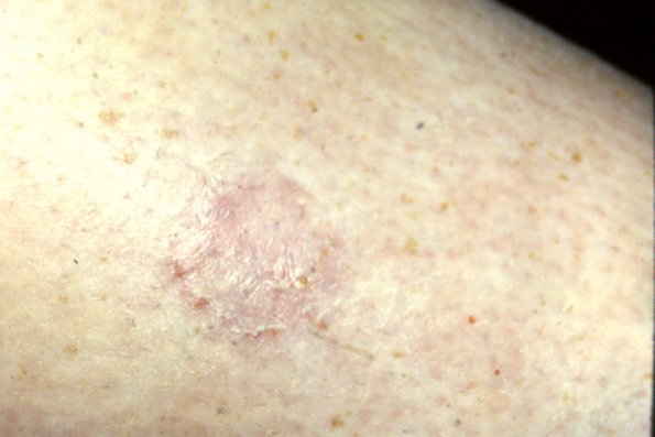 Tinea Corporis (5)