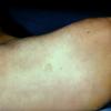 Tinea Nigra Plantaris (2)