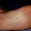 Tinea Nigra Plantaris (3)