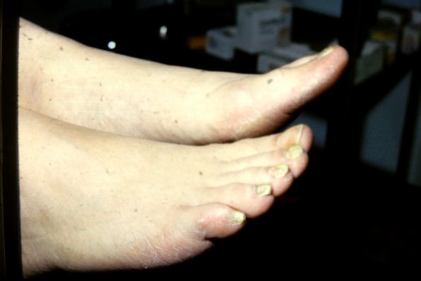 Tinea Pedis (2)