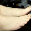 Tinea Pedis (3)