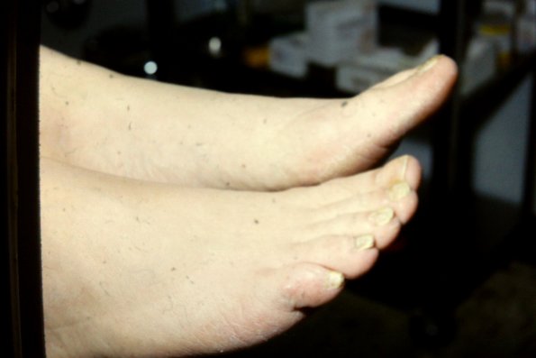 Tinea Pedis (3)