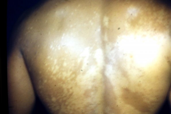 Tinea Verlicolor