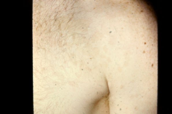 Tinea Versicolor (2)