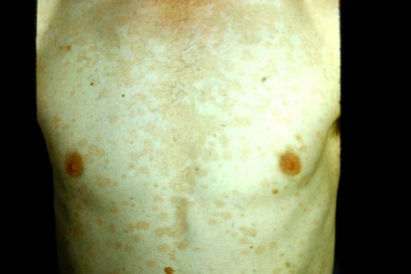 Tinea Versicolor (3)