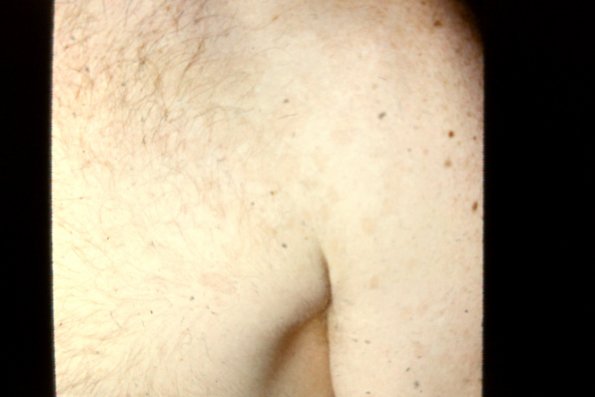 Tinea Versicolor (4)