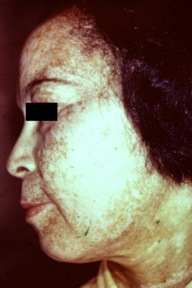 Vitiligo (15)