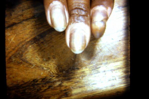 Vitiligo (5)