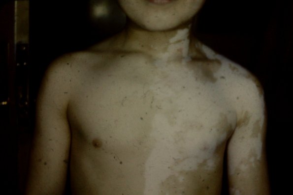 Vitiligo Segmented Vitiligo