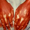 Vitiligo v Chemical Induced Loss Of Pigmentation