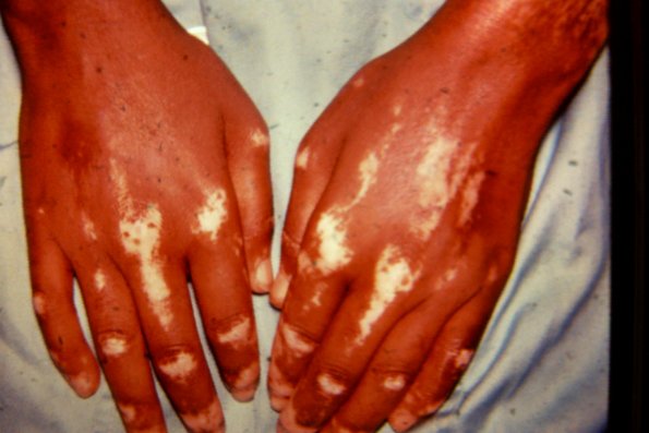 Vitiligo v Chemical Induced Loss Of Pigmentation