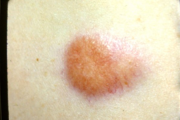 Xanthogranuloma (2)