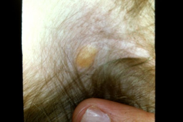 Xanthogranuloma (4)