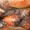 Granuloma inguinale