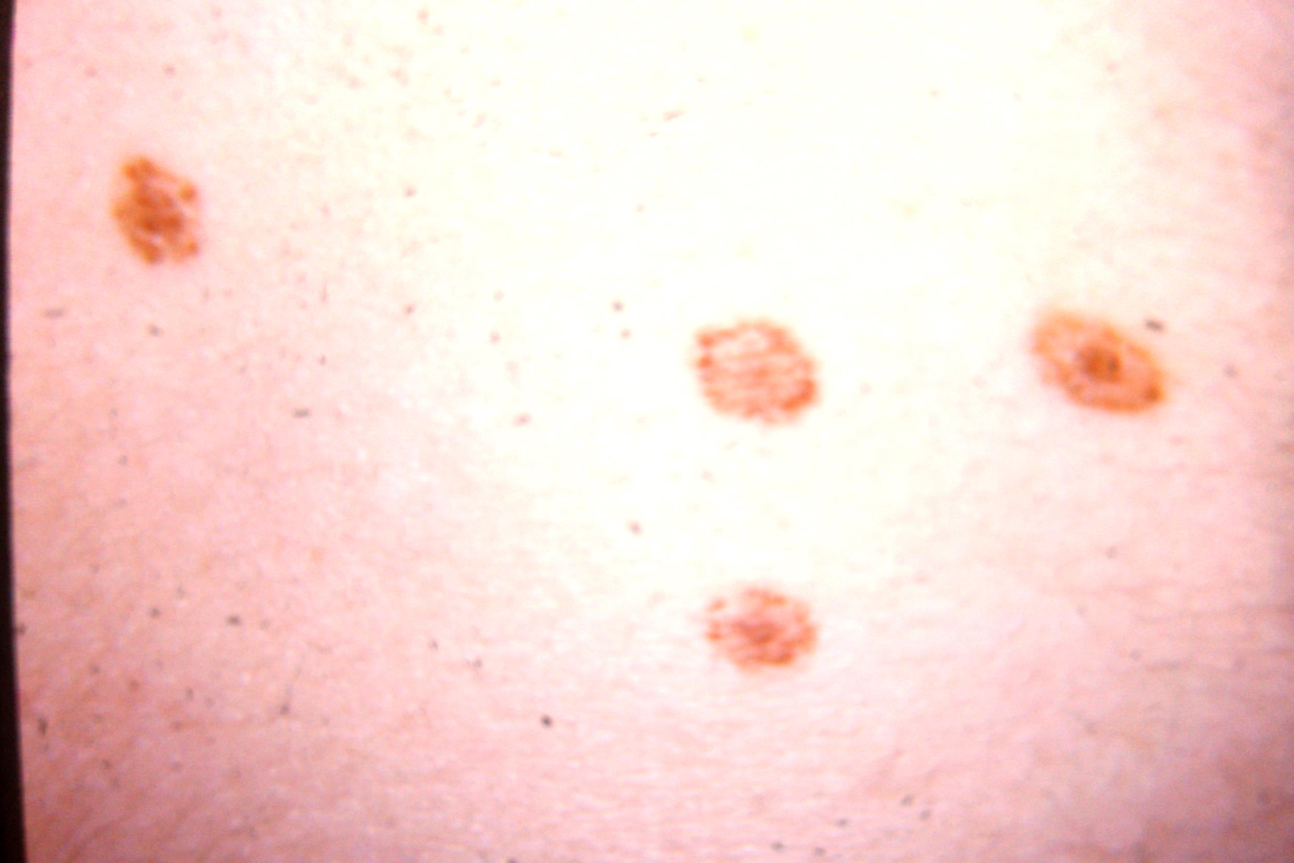 Em Rashes Mutiple EM | Erythema Multiforme | Comprehensive Dermatology Photo Atlas ...