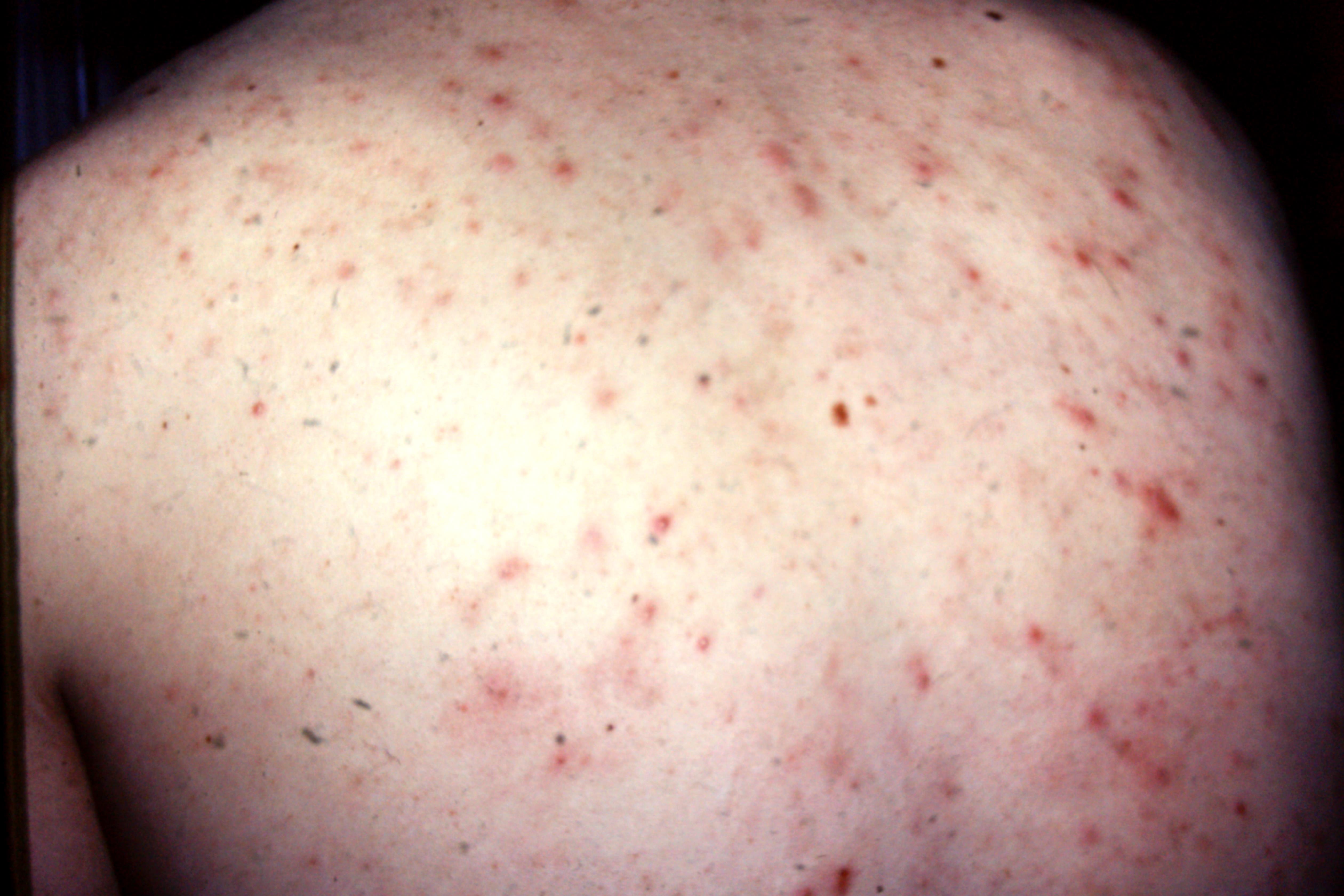 Peripheral Excoriating Rash Excoriation