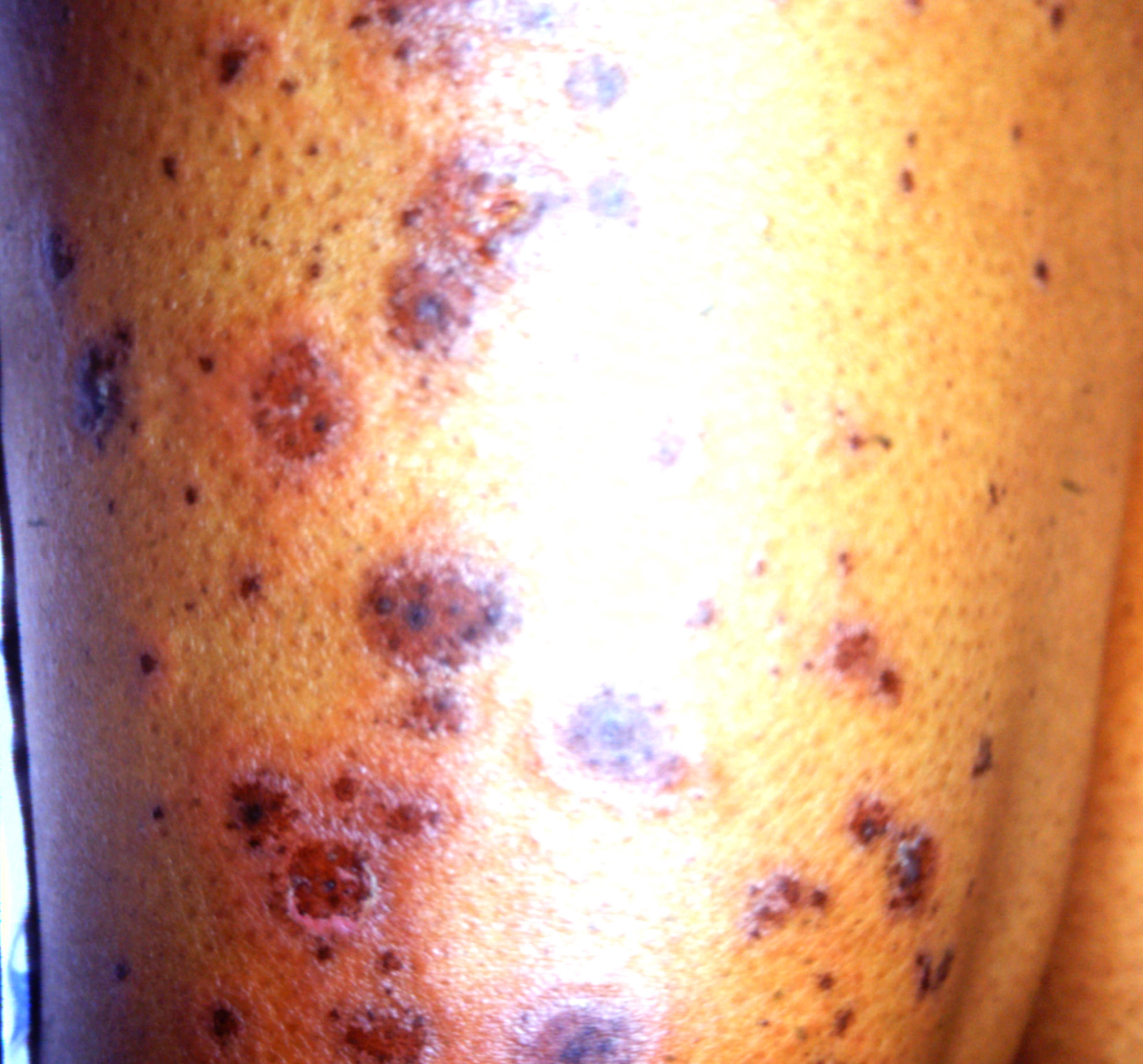Pleva | Pitiyriasis Lichenoides Et Variolaformis Acuta Pleva ...