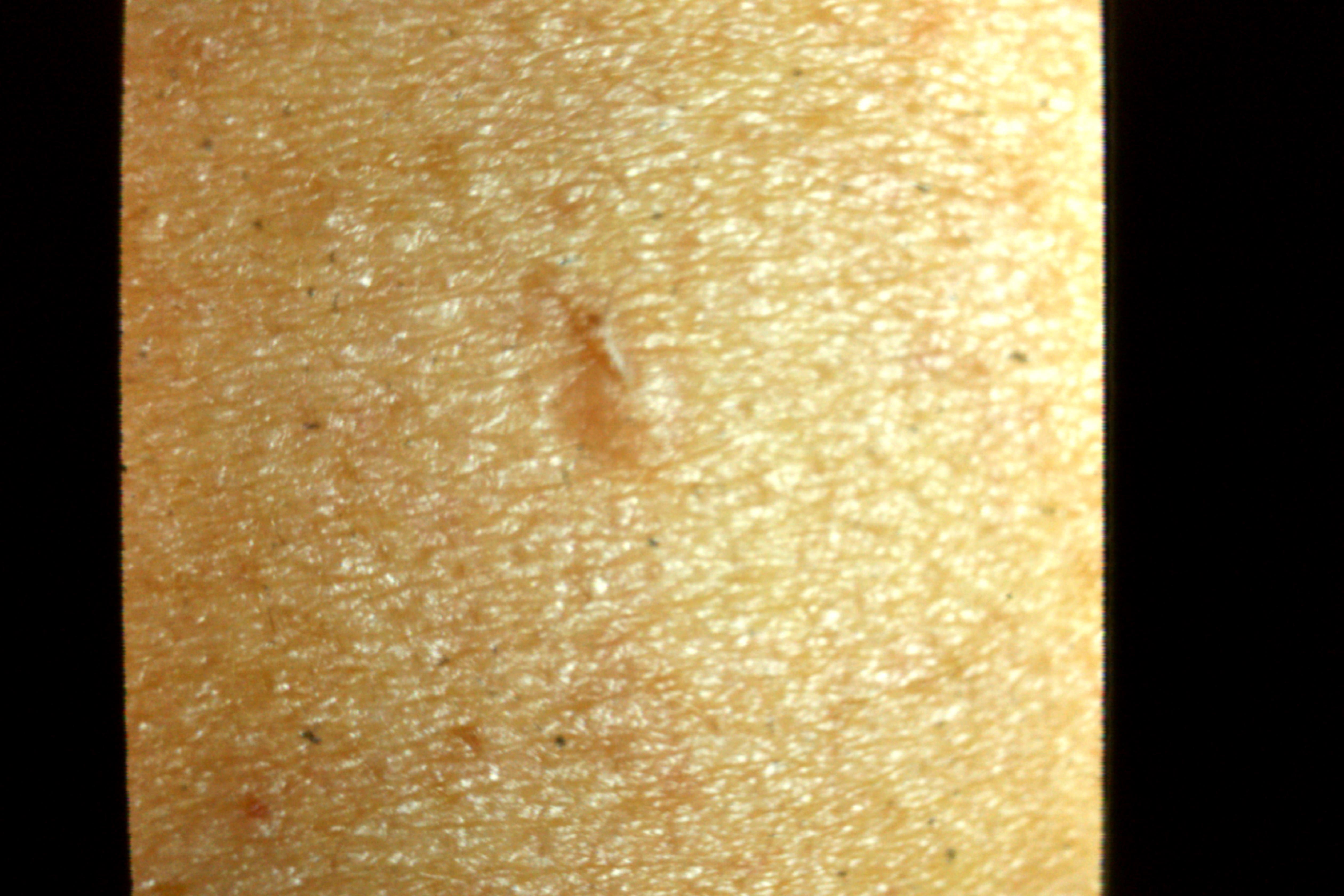 Triachos Trichofolliculoma | Trichos | Comprehensive Dermatology Photo Atlas ...
