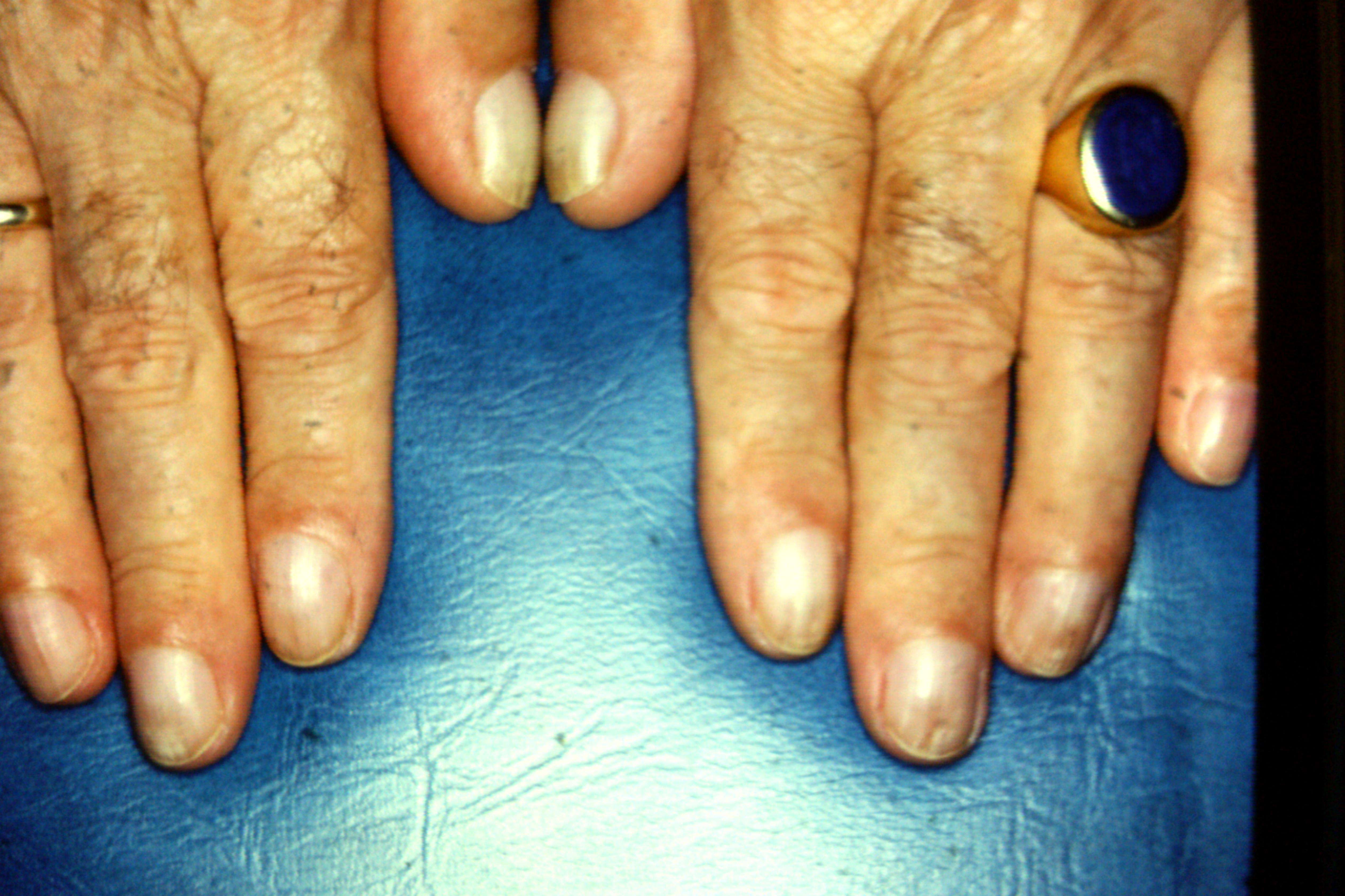Clubbed Fingernails Clubbing Nails Comprehensive Dermatology Photo Atlas Wayne State University Som Dermatology Image Atlas Wsusom Dermatology Image Atlas