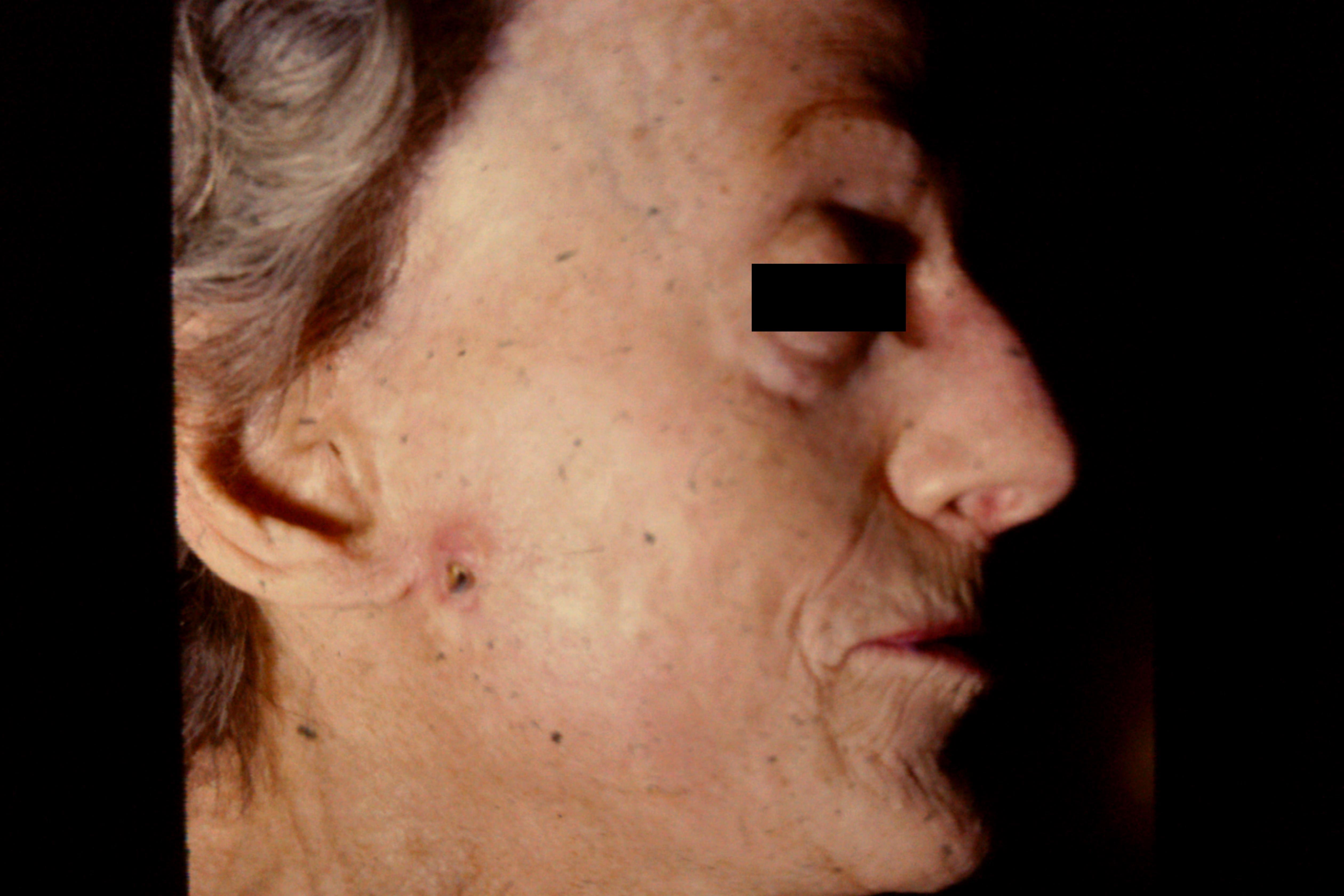 calcinosis cutis face