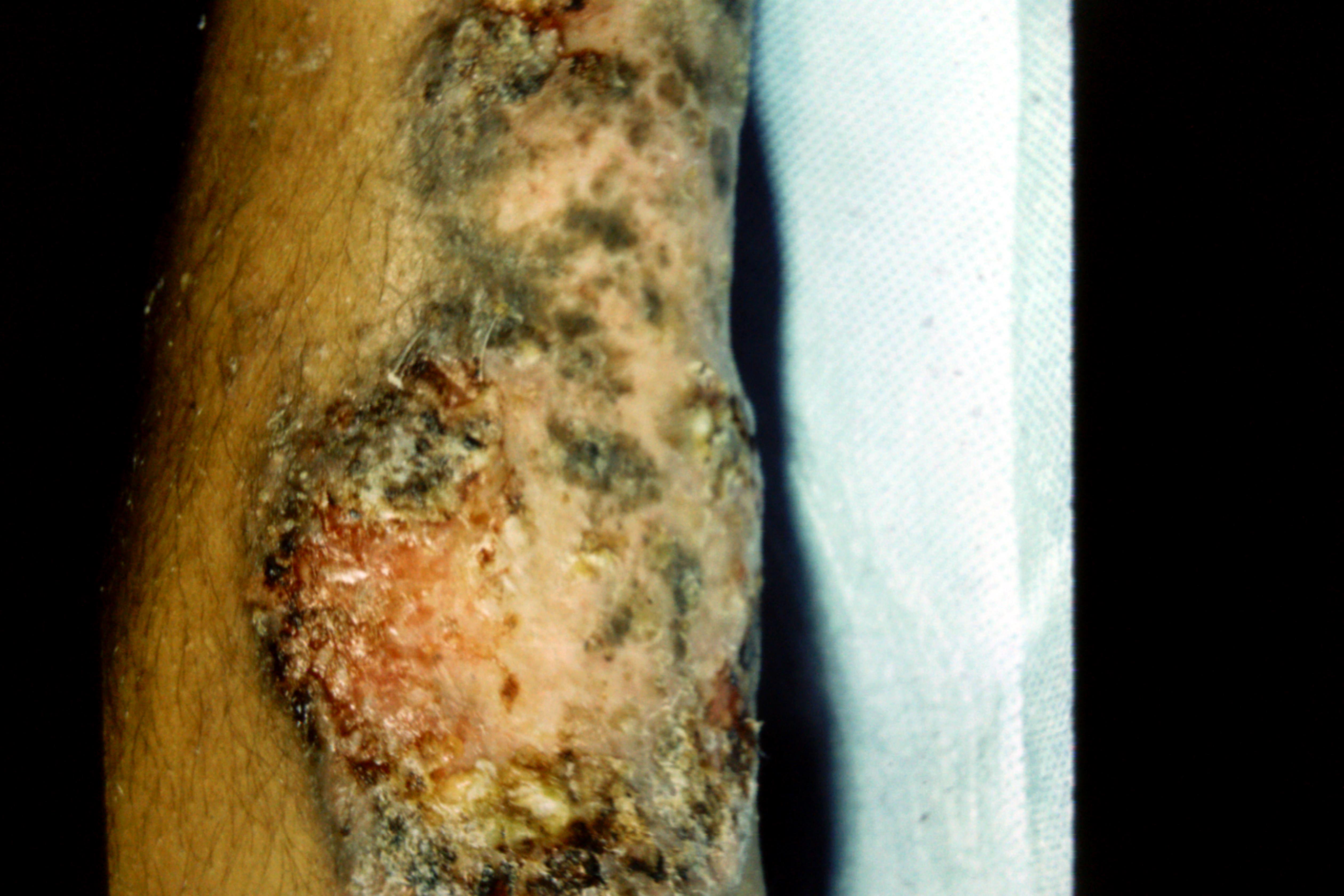 Pyoderma Gangrena Pyoderma Vegetans