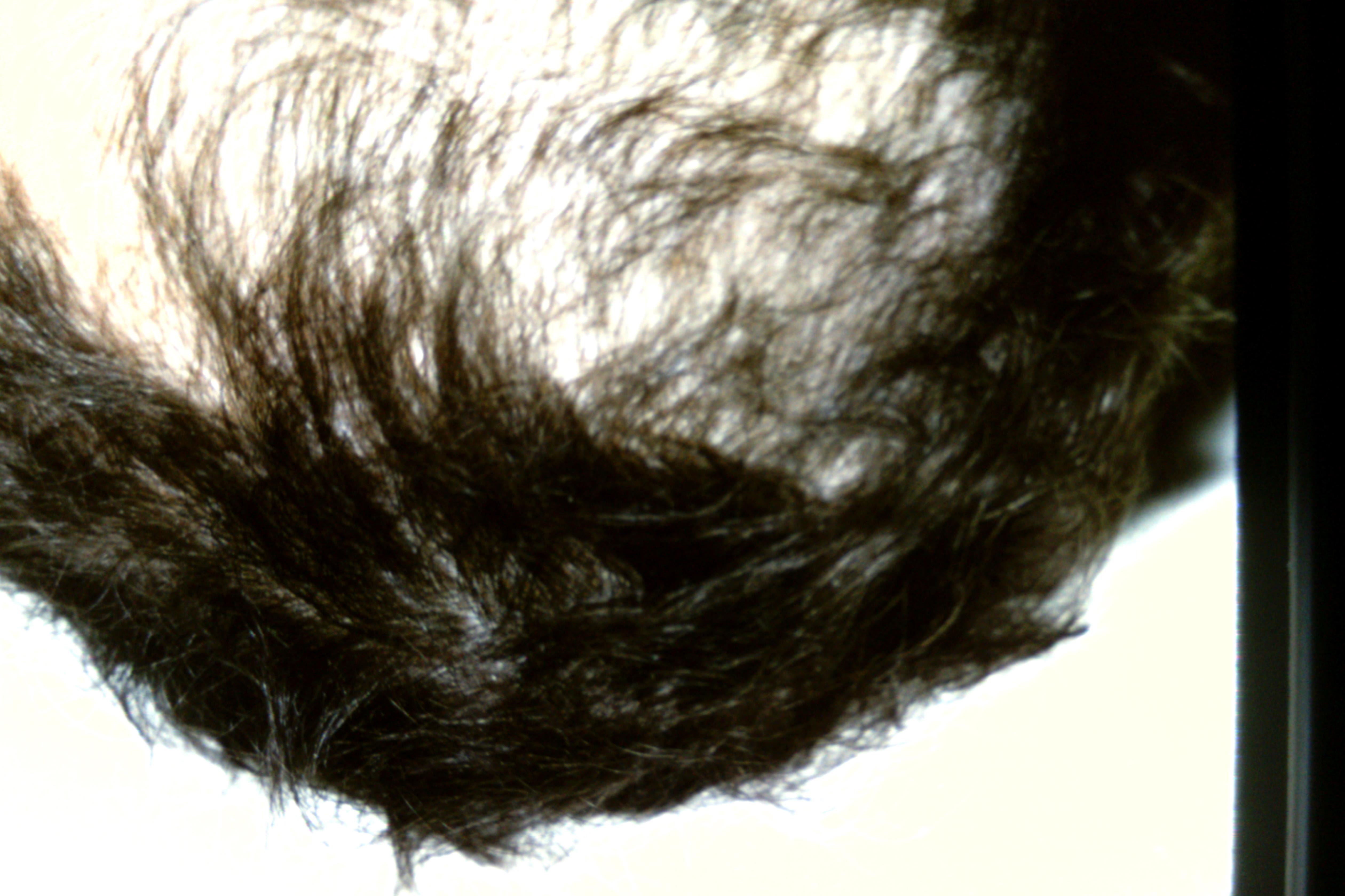 Triachos Trichotillomania | Trichos | Dr. Robert J. Schoenfeld | Wayne State ...